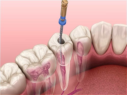 درمان ریشه و عصب کشی 