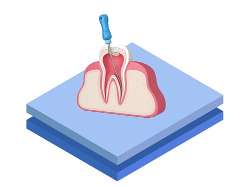 root canal